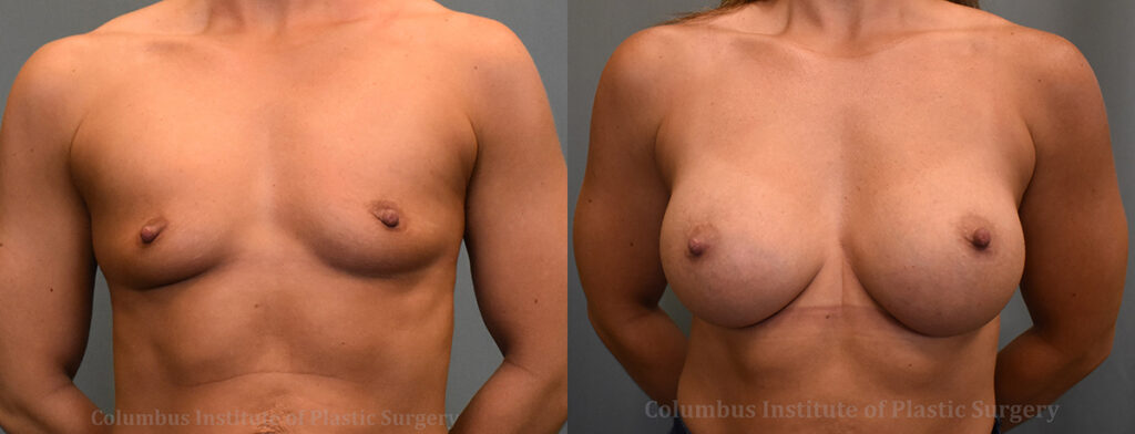 Breast Augmentation before and after photo by Columbus Institute of Plastic Surgery in Columbus, OH