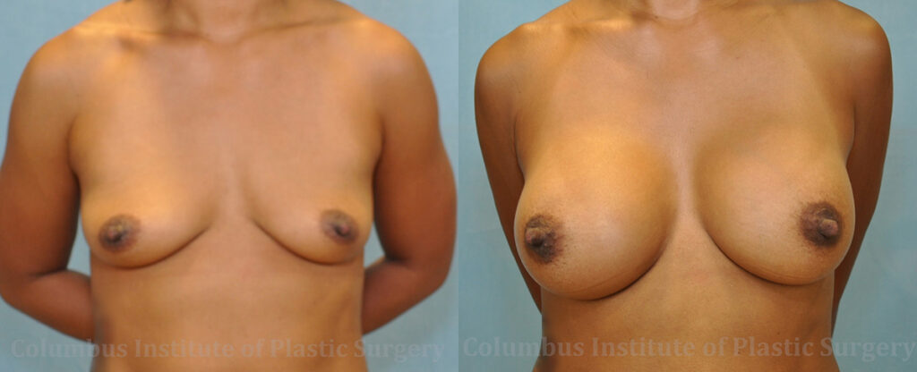 Breast Augmentation before and after photo by Columbus Institute of Plastic Surgery in Columbus, OH