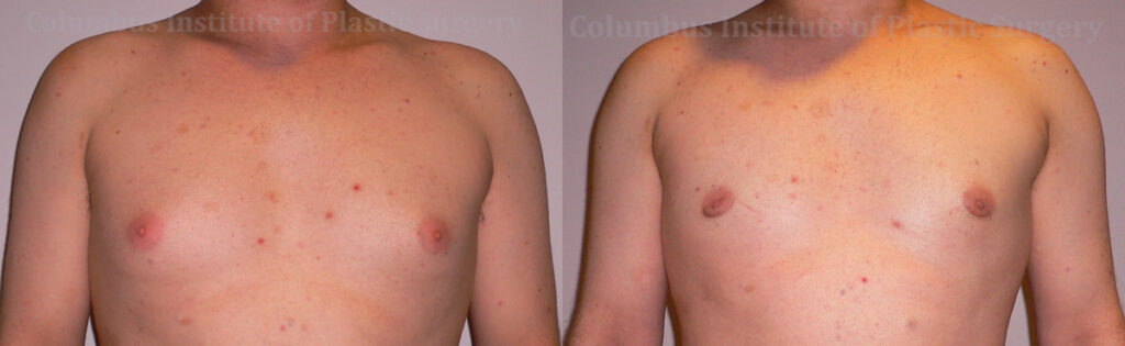 Gynecomastia before and after photo by Columbus Institute of Plastic Surgery in Columbus, OH