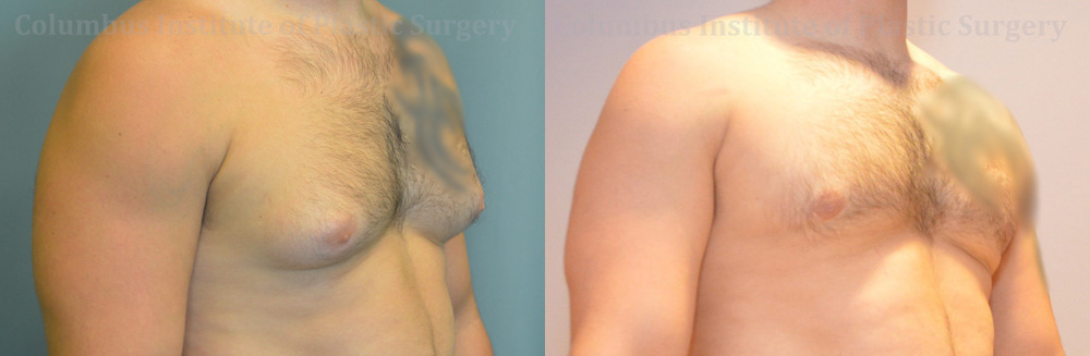 Gynecomastia before and after photo by Columbus Institute of Plastic Surgery in Columbus, OH