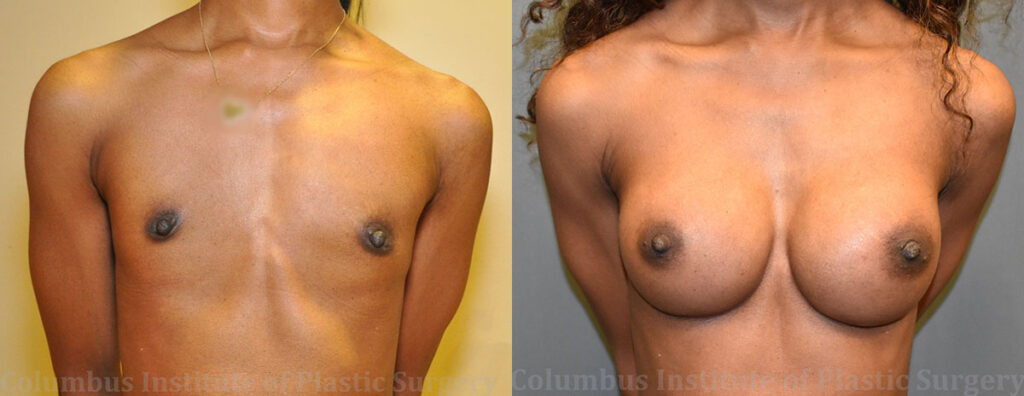 Breast Augmentation before and after photo by Columbus Institute of Plastic Surgery in Columbus, OH