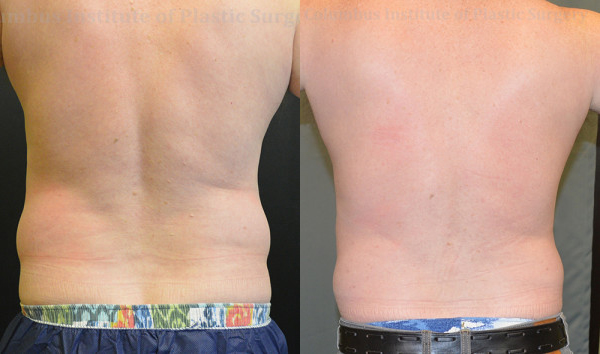 CoolSculpting before and after photo by Columbus Institute of Plastic Surgery in Columbus, OH