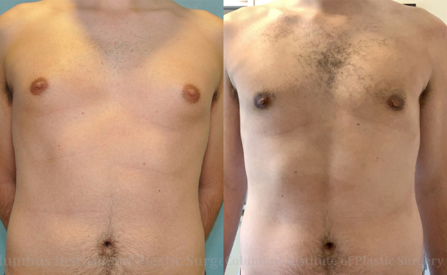 Gynecomastia before and after photo by Columbus Institute of Plastic Surgery in Columbus, OH