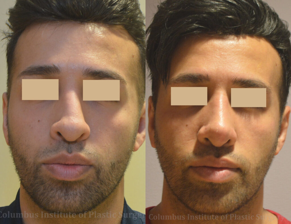 Rhinoplasty before and after photo by Columbus Institute of Plastic Surgery in Columbus, OH