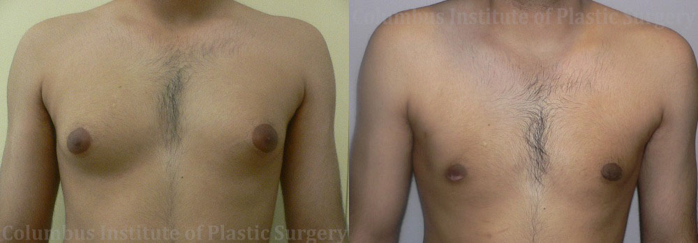 Gynecomastia before and after photo by Columbus Institute of Plastic Surgery in Columbus, OH