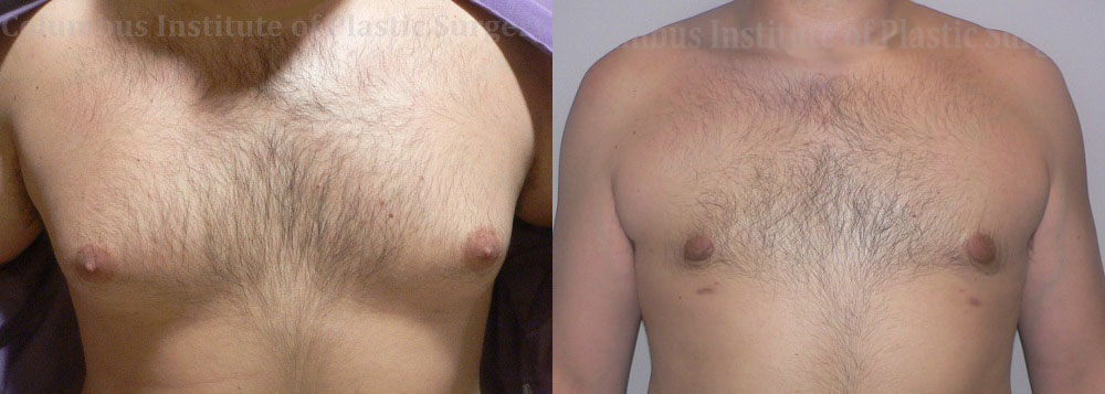 Gynecomastia before and after photo by Columbus Institute of Plastic Surgery in Columbus, OH