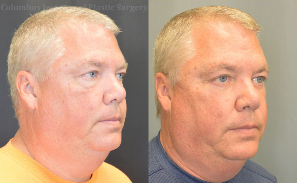 Blepharoplasty before and after photo by Columbus Institute of Plastic Surgery in Columbus, OH