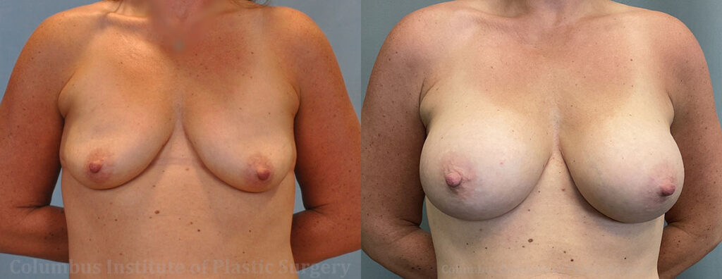 Breast Augmentation before and after photo by Columbus Institute of Plastic Surgery in Columbus, OH