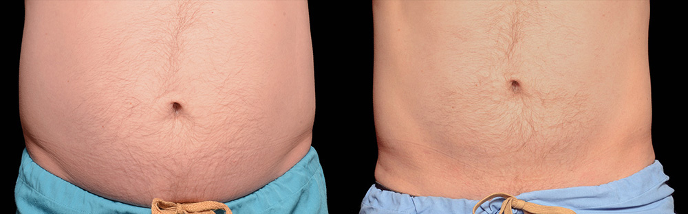 CoolSculpting before and after photo by Columbus Institute of Plastic Surgery in Columbus, OH