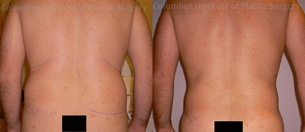 Liposuction before and after photo by Columbus Institute of Plastic Surgery in Columbus, OH