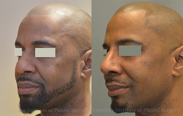 Rhinoplasty before and after photo by Columbus Institute of Plastic Surgery in Columbus, OH