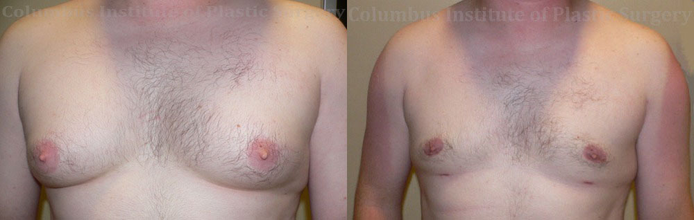 Gynecomastia before and after photo by Columbus Institute of Plastic Surgery in Columbus, OH
