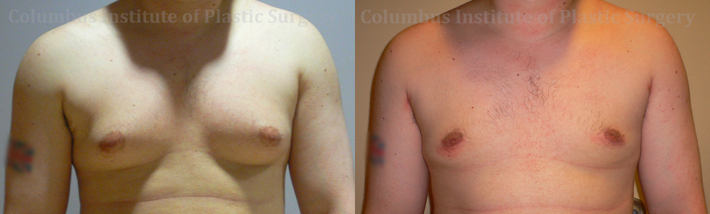 Gynecomastia before and after photo by Columbus Institute of Plastic Surgery in Columbus, OH