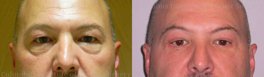 Blepharoplasty before and after photo by Columbus Institute of Plastic Surgery in Columbus, OH