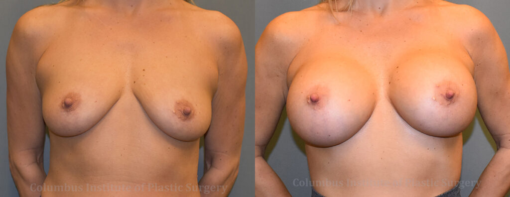 Breast Augmentation before and after photo by Columbus Institute of Plastic Surgery in Columbus, OH