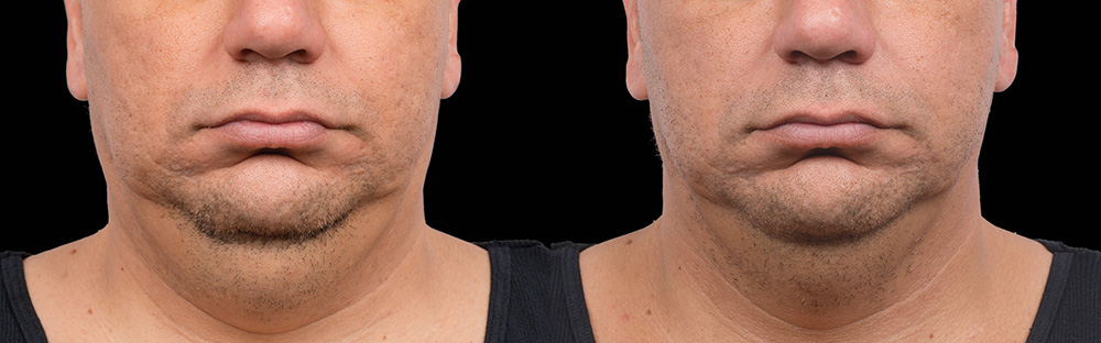 CoolSculpting before and after photo by Columbus Institute of Plastic Surgery in Columbus, OH