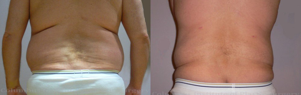 Liposuction before and after photo by Columbus Institute of Plastic Surgery in Columbus, OH