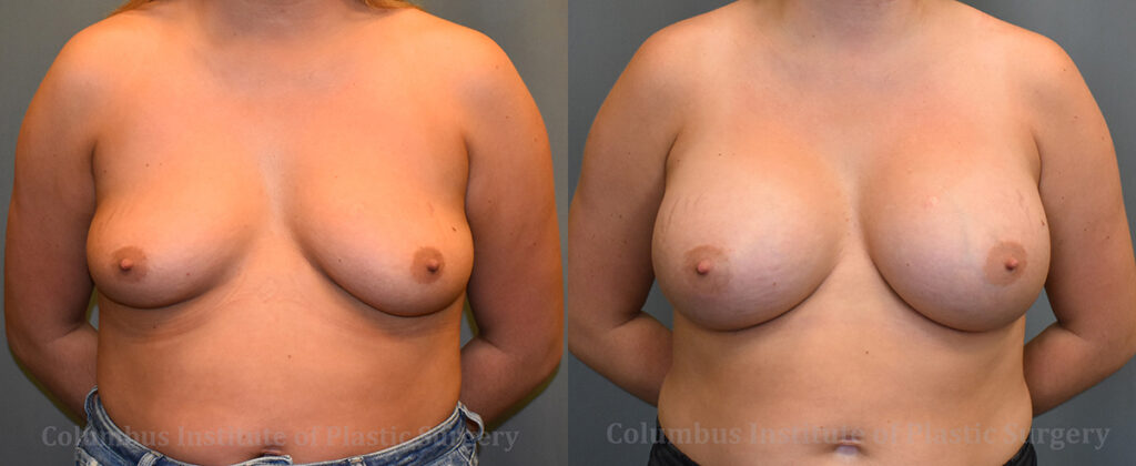 Breast Augmentation before and after photo by Columbus Institute of Plastic Surgery in Columbus, OH