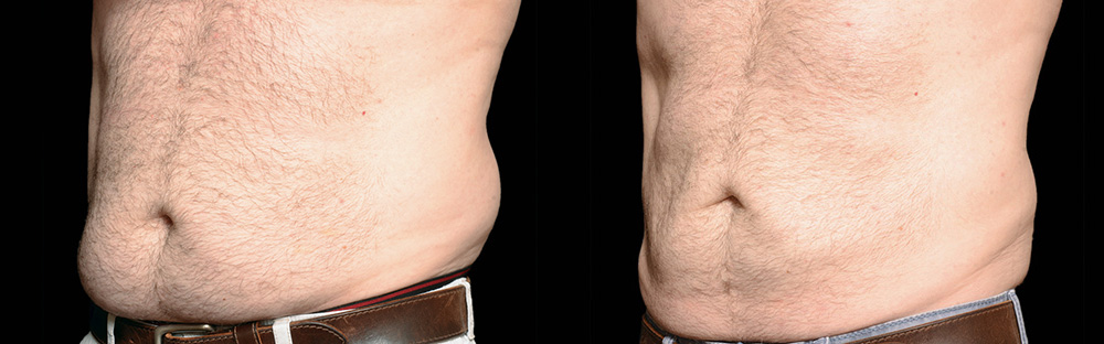 CoolSculpting before and after photo by Columbus Institute of Plastic Surgery in Columbus, OH
