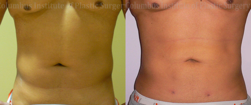 Liposuction before and after photo by Columbus Institute of Plastic Surgery in Columbus, OH