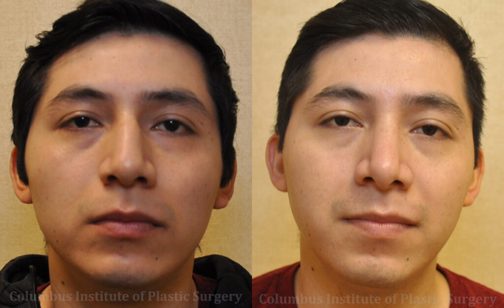 Rhinoplasty before and after photo by Columbus Institute of Plastic Surgery in Columbus, OH