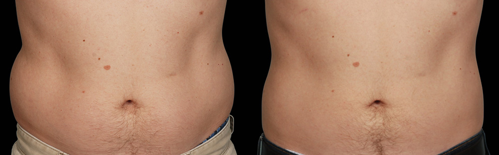 CoolSculpting before and after photo by Columbus Institute of Plastic Surgery in Columbus, OH
