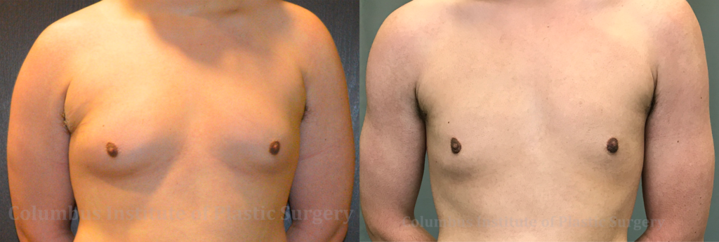 Gynecomastia before and after photo by Columbus Institute of Plastic Surgery in Columbus, OH