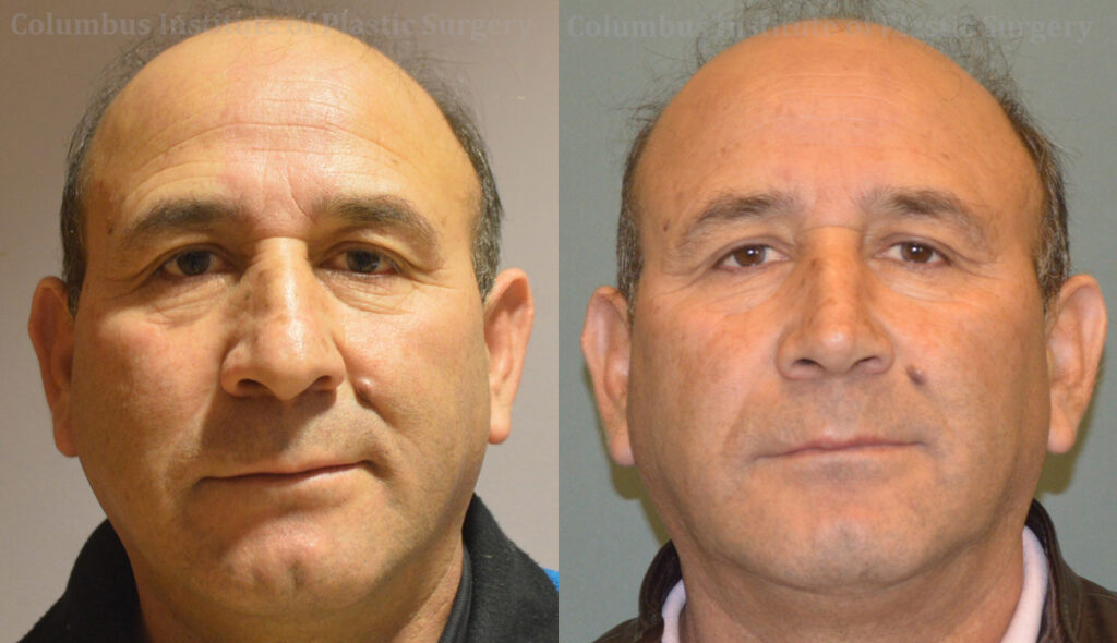 Rhinoplasty before and after photo by Columbus Institute of Plastic Surgery in Columbus, OH