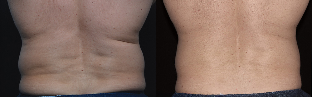 CoolSculpting before and after photo by Columbus Institute of Plastic Surgery in Columbus, OH