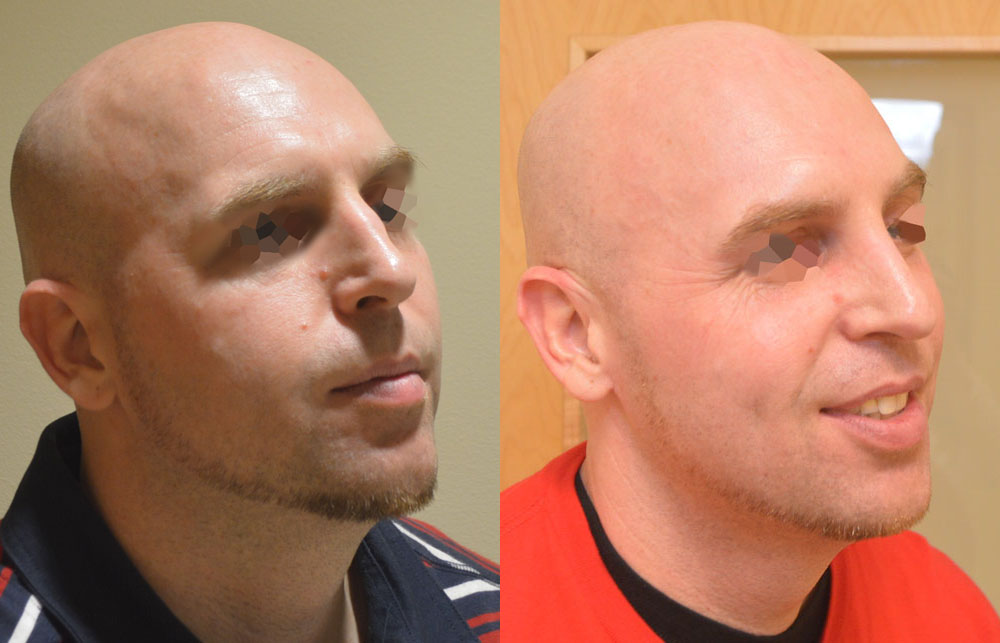 Rhinoplasty before and after photo by Columbus Institute of Plastic Surgery in Columbus, OH