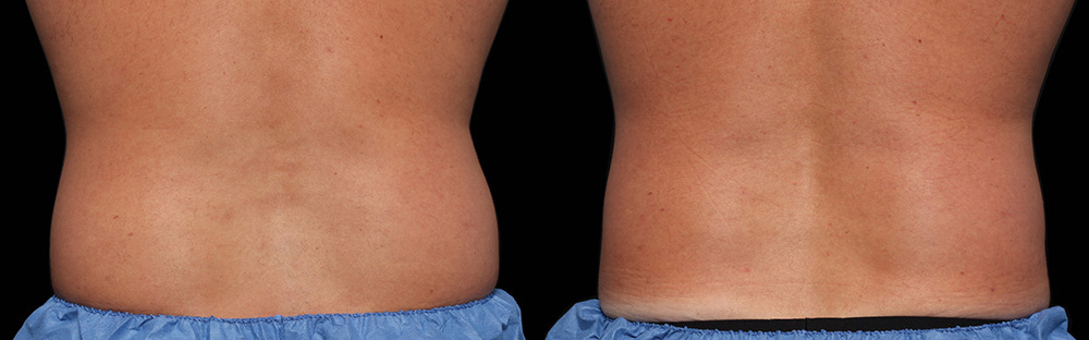 CoolSculpting before and after photo by Columbus Institute of Plastic Surgery in Columbus, OH
