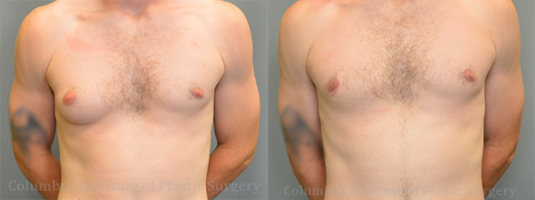 Gynecomastia before and after photo by Columbus Institute of Plastic Surgery in Columbus, OH