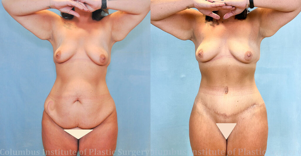 Abdominoplasty (Tummy Tuck) before and after photo by Columbus Institute of Plastic Surgery in Columbus, OH