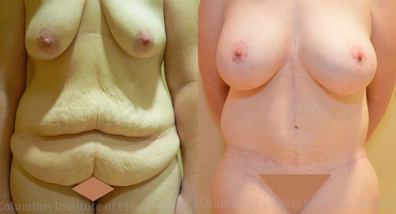 Belt Lipectomy before and after photo by Columbus Institute of Plastic Surgery in Columbus, OH