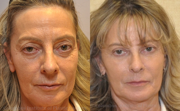 Blepharoplasty before and after photo by Columbus Institute of Plastic Surgery in Columbus, OH