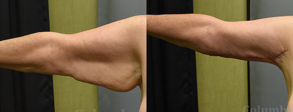 Brachioplasty (Arm Lift) before and after photo by Columbus Institute of Plastic Surgery in Columbus, OH
