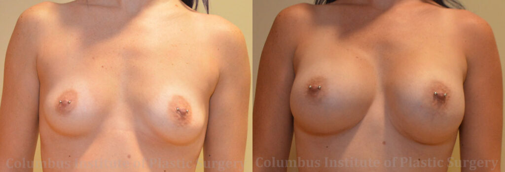 Breast Augmentation with Gummy Bear (Form Stable) Implants before and after photo by Columbus Institute of Plastic Surgery