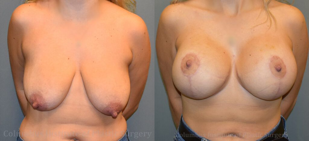 Breast Augmentation – 500cc-600cc before and after photo by Columbus Institute of Plastic Surgery in Columbus, OH