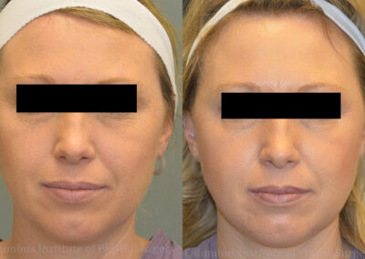 TCA Chemical Peel | Before & After Photos