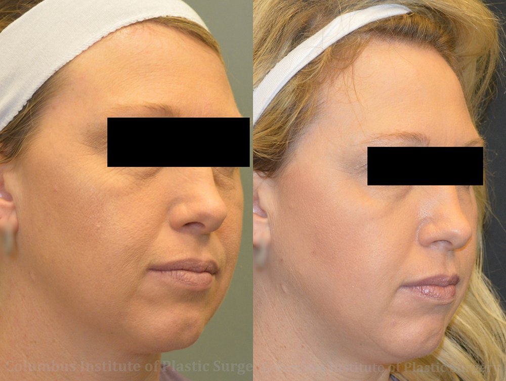 TCA Chemical Peel before and after photo by Columbus Institute of Plastic Surgery in Columbus, OH TCA Chemical Peel before and after photo by Columbus Institute of Plastic Surgery in Columbus, OH