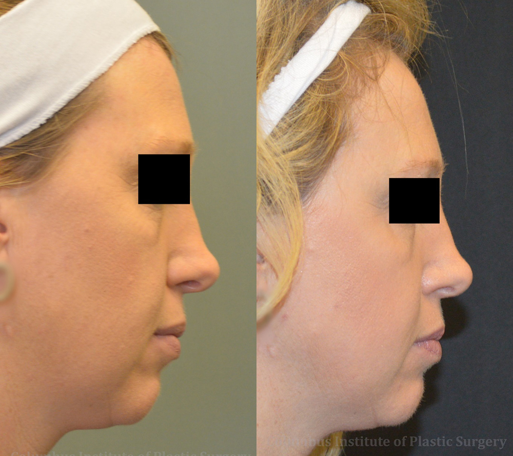 TCA Chemical Peel before and after photo by Columbus Institute of Plastic Surgery in Columbus, OH TCA Chemical Peel before and after photo by Columbus Institute of Plastic Surgery in Columbus, OH