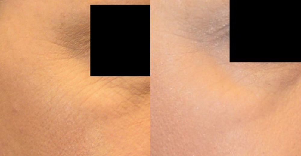 TCA Chemical Peel before and after photo by Columbus Institute of Plastic Surgery in Columbus, OH TCA Chemical Peel before and after photo by Columbus Institute of Plastic Surgery in Columbus, OH