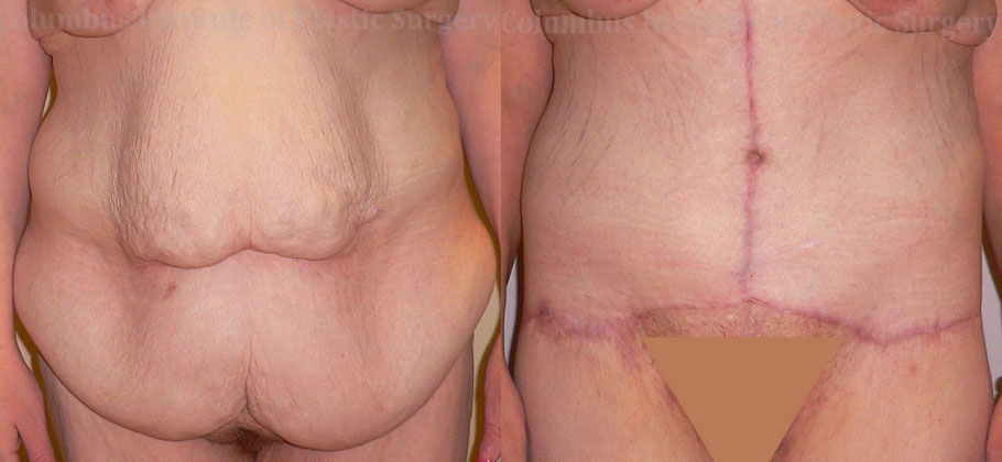 Belt Lipectomy before and after photo by Columbus Institute of Plastic Surgery in Columbus, OH