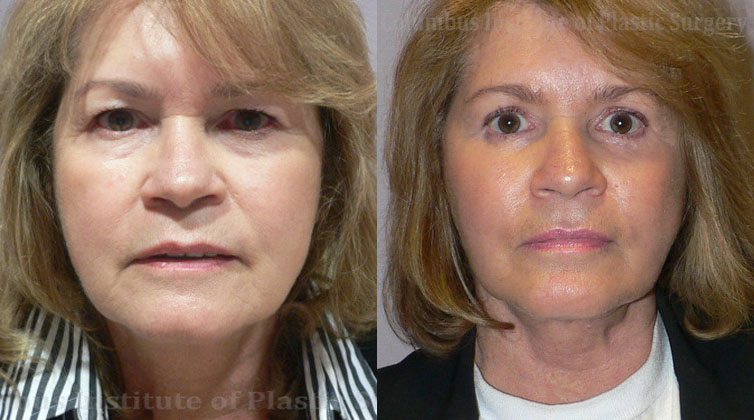Blepharoplasty before and after photo by Columbus Institute of Plastic Surgery in Columbus, OH