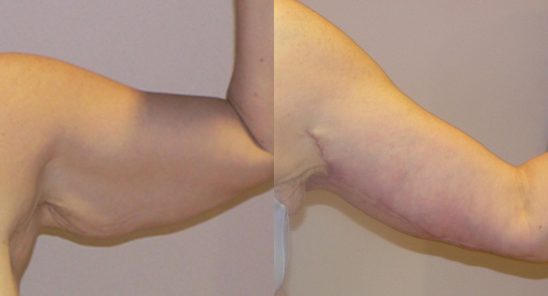 Brachioplasty (Arm Lift) before and after photo by Columbus Institute of Plastic Surgery in Columbus, OH