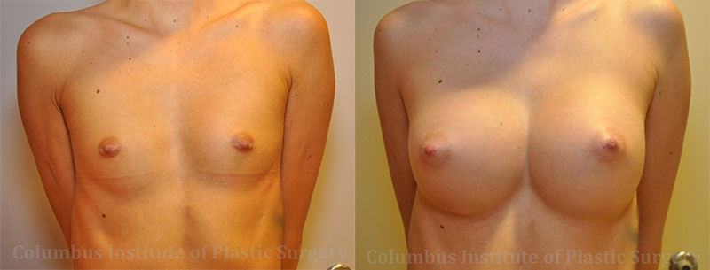 Breast Augmentation – 300cc-400cc before and after photo by Columbus Institute of Plastic Surgery in Columbus, OH