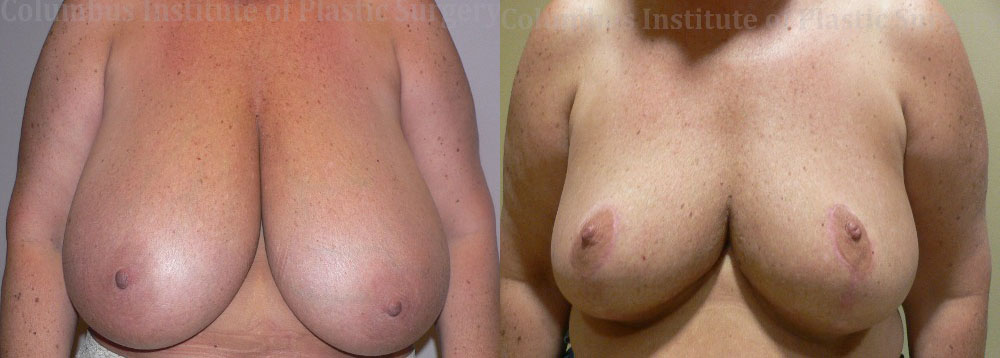 Breast Reduction before and after photo by Columbus Institute of Plastic Surgery in Columbus, OH