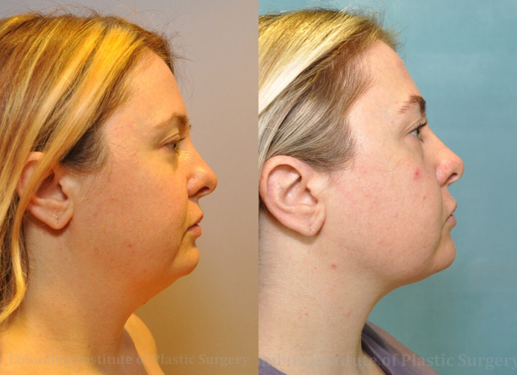 Liposuction before and after photo by Columbus Institute of Plastic Surgery in Columbus, OH