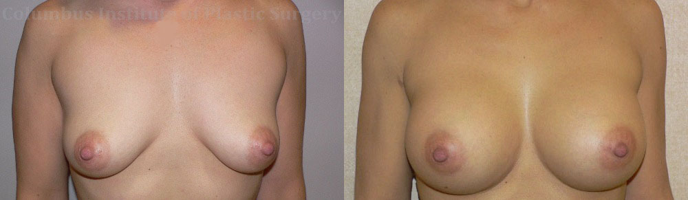Breast Augmentation – 400cc-500cc before and after photo by Columbus Institute of Plastic Surgery in Columbus, OH