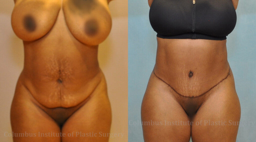 Abdominoplasty (Tummy Tuck) before and after photo by Columbus Institute of Plastic Surgery in Columbus, OH